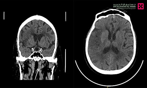 مستشفى الدكتور سليمان الحبيب بالصحافة ينقذ حياة "سبعيني" مصاب بجلطة وريدية دماغية عميقة بالأشعة التداخلية