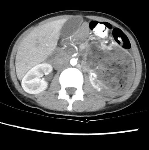 تقنية الأشعة التداخلية تُنقذ حياة شابة من ورم خطير بالكلية في مجمع الملك فيصل الطبي