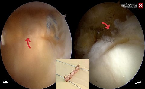 مجمع الدكتور سليمان الحبيب بالعليا يُجري عملية معقدة لبناء غضروف الورك لعشرينية وينهي معاناة استمرت 7 سنوات