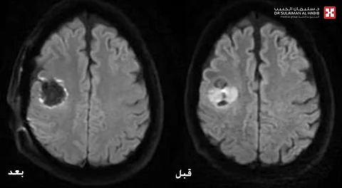 مستشفى الدكتور سليمان الحبيب بالريان ينجح في استئصال ورم بالدماغ باستخدام جهاز الملاحة العصبية