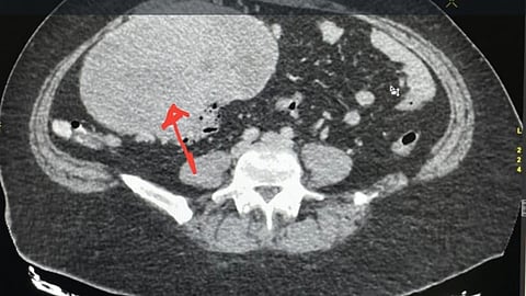 مجمع الملك فيصل الطبي بالطائف ينقذ مريضة من ورم عصبي ضخم
