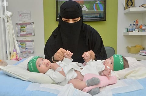 اليوم العالمي "للتوائم الملتصقة".. العالم يحتفل بمبادرة المملكة