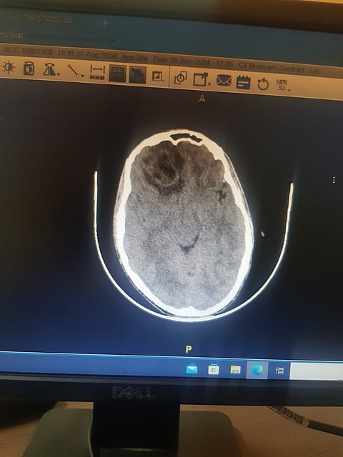 تشنجات صرعية داهمته.. جراحة معقدة تنقذ شابًا من خُراج بالدماغ في الطائف