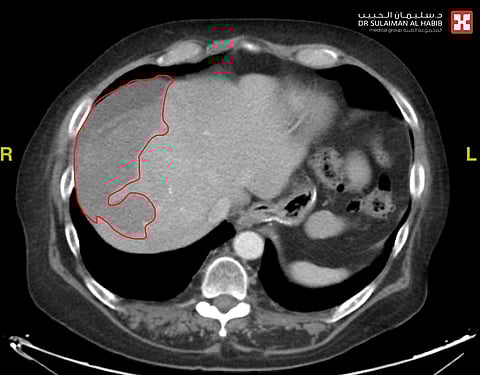 مستشفى الدكتور سليمان الحبيب بالقصيم يُنهي نزيفًا حادًّا بالكبد لستيني خلال "50" دقيقة بالأشعة التداخلية