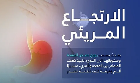 "القصيم الصحي": المشروبات الغازية والتدخين تزيد فرص الإصابة بالارتجاع المريئي