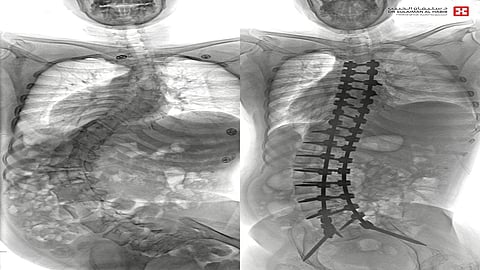مستشفى الدكتور سليمان الحبيب بالقصيم يُعيد "أربعينية" مصابة بالجنف وميلان الحوض إلى الحياة الطبيعية
