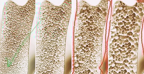 57 % من النساء فوق الستين يعانين هشاشة العظام.. و"الخضيري" يحذر من المضاعفات الخطيرة