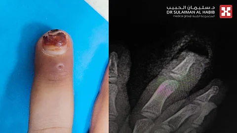 مستشفى الدكتور سليمان الحبيب بالريان ينجح في إعادة زراعة جزء من إصبع مبتور لطفلة بعمر 5 سنوات