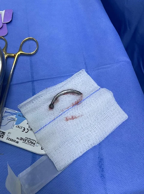 مسمار يخترق قلب شاب.. وفريق طبي من مستشفى الملك عبدالعزيز التخصصي بالطائف ينجح في إنقاذ حياته
