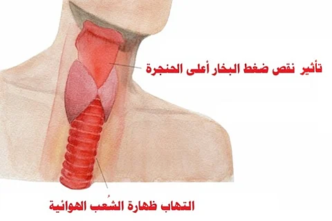 "الحرارة والجفاف والغشاء المخاطي البشري".. دراسة: الاحتباس الحراري يزيد خطر التهاب الشعب الهوائية
