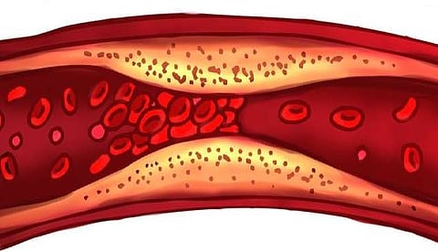 "المركّب الذهبي" لمرضى القلب.. دراسة تكشف أفضل علاج لخفض مستويات الكوليسترول "الضار"