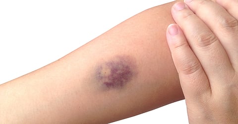 العلامات الزرقاء.. مؤشر صحي لا يجب تجاهله