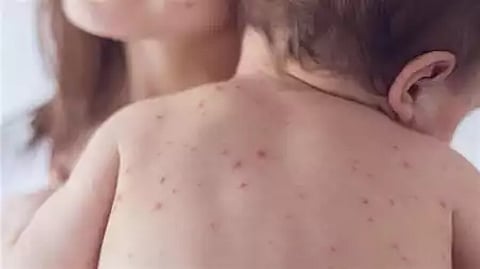 انتشار مستمر.. إصابات الحصبة تتخطى 700 في 6 ولايات أميركية