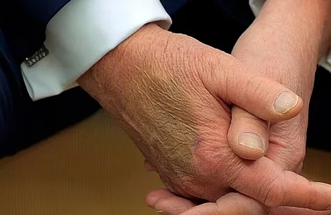 كدمة غامضة على يد ترامب اليمنى تعود مجددًا وتفتح باب التساؤلات