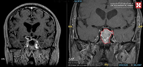 مستشفى الدكتور سليمان الحبيب بالقصيم يُنقذ مسن من ورم دماغي سبب قصور شديد بالوعي