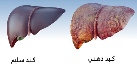 نجح بعلاج 62.9 % من المرضى.. دراسة: دواء شهير للسكري والسمنة يعالج مرض الكبد الدهني بفعالية
