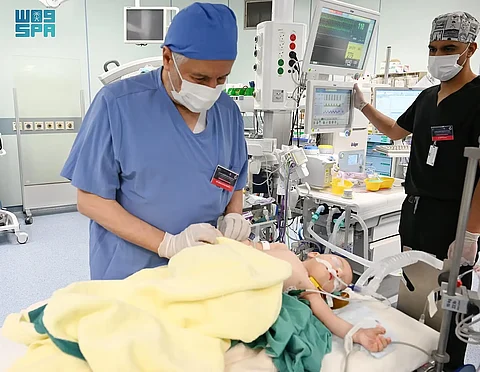 نجاح المرحلة الثالثة من عملية فصل التوأم الطفيلي المصري في الرياض