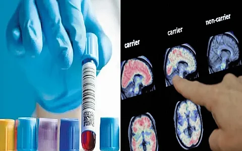 لأول مرة.. تشخيص الزهايمر بفحص عيّنة من الدم
