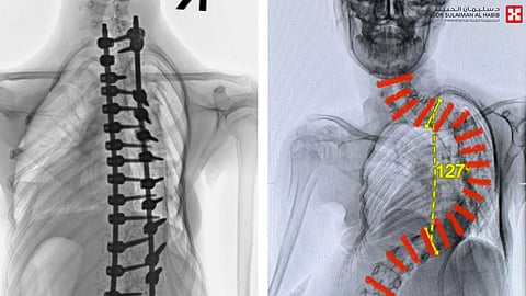 مستشفى الدكتور سليمان الحبيب بالقصيم يعيد "طفلة" مصابة بالجنف وميلان الحوض إلى الحياة الطبيعية