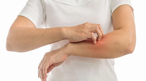 من الحساسية إلى حروق الشمس.. كيف تحمى نفسك من الأمراض الجلدية صيفاً؟