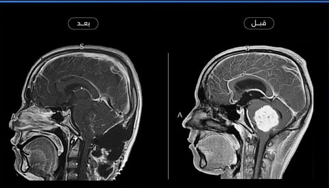 في عملية نادرة.. فريق طبي بحائل يزيل ورمًا دماغيًا من شاب عشريني بنجاح