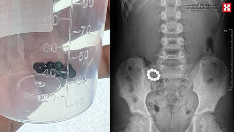 مستشفى الدكتور سليمان الحبيب بالصحافة ينقذ حياة طفل ابتلع "10" كرات مغناطيسية