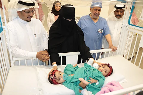 بدء عملية فصل التوأم السيامي السعودي "يارا ولارا" في الرياض