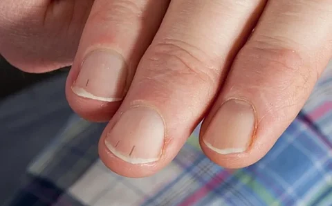 علامات خفية في الأظافر قد تكشف أمراض القلب قبل ظهور أعراضها