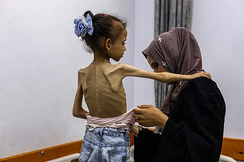 الأمم المتحدة: وفاة 8 أشخاص في غزة خلال 24 ساعة بسبب سوء التغذية