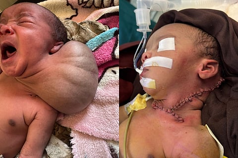 فريق طبي ينقذ حياة رضيع عمره 4 أيام من تشوّه خطير في الرقبة بالصومال الإثيوبي