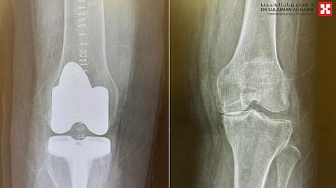 مستشفى الدكتور سليمان الحبيب بالخبر يجري عملية ناجحة لاستبدال مفصلي الركبة ويعيد الحركة لـ"سبعينية"