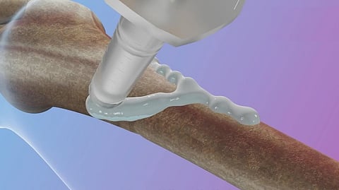 علماء صينيون يطورون "غراء عظمي" يصلح الكسور خلال 3 دقائق فقط