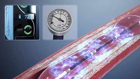 بالموجات الترددية.. مستشفى الملك فهد ينجح في تفتيت تصلب شرايين متقدم