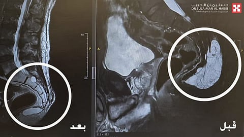 مستشفى الدكتور سليمان الحبيب بالقصيم يستأصل ورماً بالظهر لمراجع من جنوب افريقيا يعاني منه منذ سنين عديدة