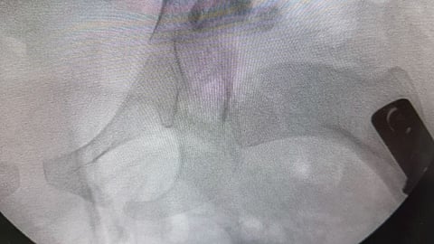 نجاح عملية نادرة لطفلة مصابة بخلع ولادي مزدوج في "مستشفى المانع" بالخبر