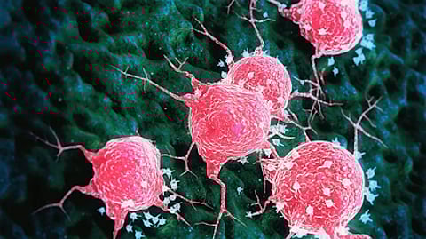 أمل جديد لمرضى سرطان البروستاتا المتقدم.. دراسة: تركيبة ثورية تخفّض خطر تطوّر المرض