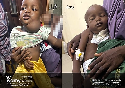 في موقف إنساني مؤثر.. فريق طبي سعودي ينقذ رضيعًا نيجيريًّا قبيل مغادرته المستشفى