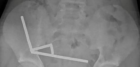 تحذيرات من تسوق الأطفال الإلكتروني.. مراهق نيوزيلندي ابتلع 100 مغناطيس وجراحة تنقذ أمعاءه