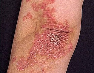 في اليوم العالمي للتوعية بالصدفية.. ما هي أنواع الصدفية وأعراضها وطرق العلاج ؟