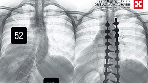 مستشفى الدكتور سليمان الحبيب بالفيحاء في جدة ينهي معاناة فتاة مع "جنف" مزدوج بدرجة عالية جداً