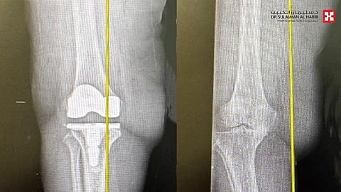 مستشفى الدكتور سليمان الحبيب بالخبر يجري عملية استبدال ركبة ناجحة باستخدام الروبوت الجراحي تحت التخدير النصفي