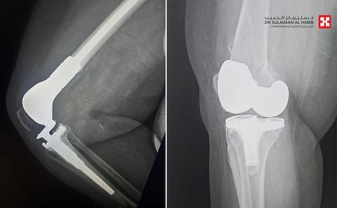 مستشفى الدكتور سليمان الحبيب بالسويدي يستبدل عظمة الفخذ بعملية متقدمة ويعيد "الحركة" لمسنة