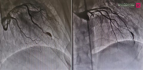 مستشفى الدكتور سليمان الحبيب بالتخصصي يزيل انسدادات ويصلح توسعاً في الشرايين التاجية للقلب بتقنية حديثة