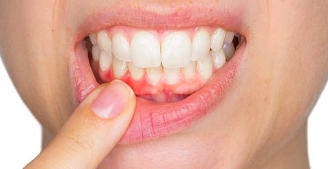 التهابات الفم والمادة البيضاء.. دراسة تحذر: أمراض اللثة قد ترتبط بالسكتة الدماغية والضعف الإدراكي