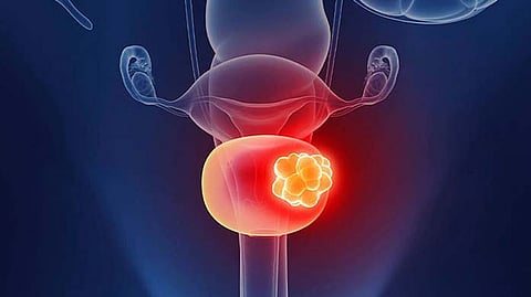 علاج جديد يمحو أورام المثانة بالكامل لدى 82% من المرضى