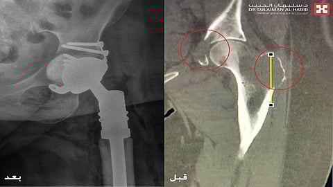 مستشفى الدكتور سليمان الحبيب بالمحمدية في جدة يُنهي معاناة خمسينية مع ورم سرطاني بعظمة الفخذ