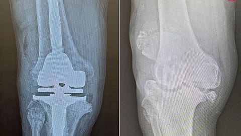 مستشفى الدكتور سليمان الحبيب بالقصيم ينهي معاناة "ستيني" مع اعتلال يسبب تآكل العظم بعملية استبدال مفصل ركبة نوعية