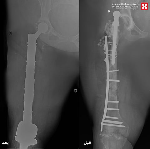 مستشفى الدكتور سليمان الحبيب بالخبر يستبدل مفصلي الركبة والورك وعظمة الفخذ ويزيل ورما وزنه "20" كجم ويعيد "الحركة" لـ"ستينية"