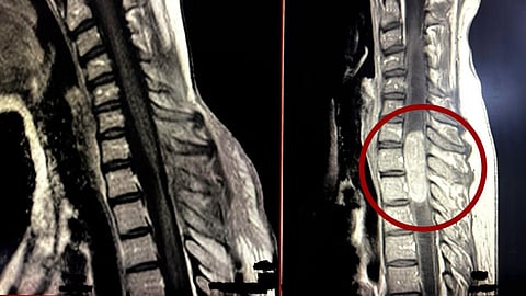 مصحوب بتوسع نخاعي ضخم.. استئصال ورم معقّد داخل الحبل الشوكي في مدينة الملك سلمان الطبية بالمدينة المنورة
