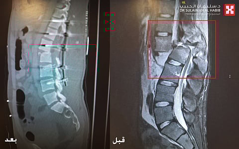 مستشفى الدكتور سليمان الحبيب بالريان يُنهي معاناة عشريني مع الشلل التام بعد تعرضه لكسر العمود الفقري نتيجة حادث مروع